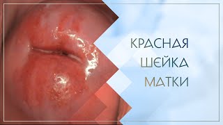 Красная шейка матки