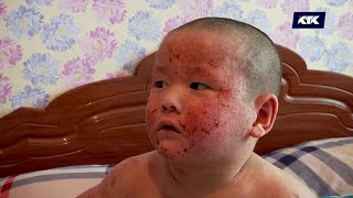 Дау-дамайсыз: Дәрігерлердің қарауынсыз қалған қышыма бала