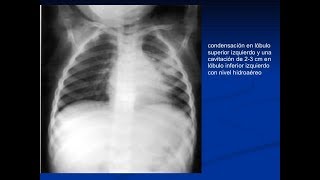 RADIOLOGIA PEDIATRICA: TORAX parte 2