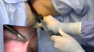 Uterine Manipulator