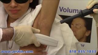 Laser Hair Removal Demonstration 2 Underarms - A E Skin - Encino, CA - 818-835-1833