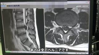 腰椎椎間板ヘルニア手術（PELD）症例解説【岩井整形外科内科病院】