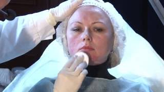 Коррекция носослезной борозды, подбородка, морщин марионетки препаратом PRINCESS FILLER (Австрия)