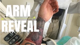 FTM Phalloplasty Seeing My Arm For The First Time
