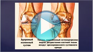 Сложность Артроза.
