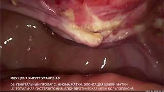 Генитальный пролапс. Тотальная гистерэктомия. Mesh-вагинопексия