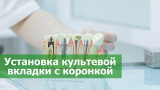 Зубная коронка. Установка культевой вкладки с коронкой в стоматологии ПрезиДЕНТ в Марьино