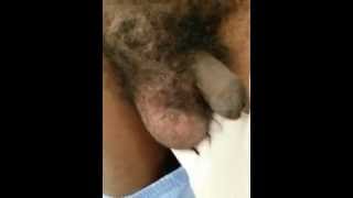 Hydrocele