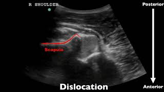 POCUS - Evaluating for shoulder dislocation with ultrasound