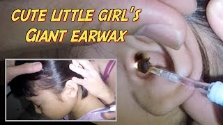 Cute Little Girl's Giant Earwax Removal