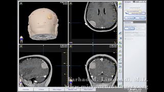 Occipital Meningioma surgical removed with Craniotomy