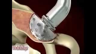 Chirurgie mini invasive antérieure de hanche pour implantation de prothèse totale.
