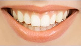 Astuce pour blanchir les dents naturellement  (rapide et facile) HD