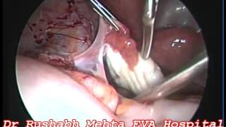 Diagnostic Laproscopy of Normal female pelvis