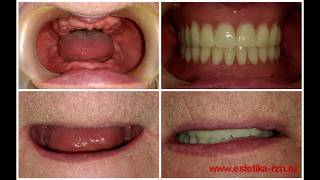 Современные полные съемные пластиночные протезы. 4-я стоматология (4 ГКСП).10.03.2019