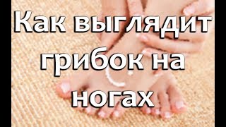 Как выглядит грибок на ногах - признаки и формы