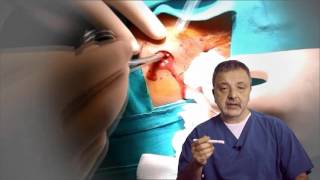 Anorectal abscess/ fistula - Concomitant drainage plus hybrid seton