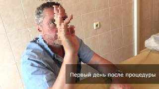 Контрактура Дюпюитрена - Ліпофілінг- Петах А.В Гришай С.Е