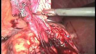 Laparoscopic dismembered Anderson-Hynes pyeloplasty with resection of the pelvis