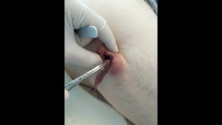 SUPER PIMPLE!!! Большой прыщ!!!
