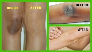 হাঁটু ও কনুইয়ের গাঢ় কালো দাগ দূর করুন মাত্র ১০ মিনিটে II Mim Beauty Tips