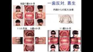 京都府長岡京市 京都府長岡京市・矯正専門医 【子供の見えない抜かない矯正】ブラケットなし来院少ないオリジナル矯正装置