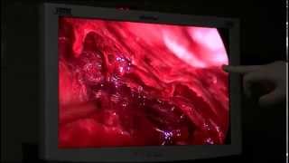 Торакоскопия после операции на сердце. Thoracoscopy for bleeding after cardiac surgery.