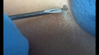 Removing Ingrown Hairs Before Electrolysis Session