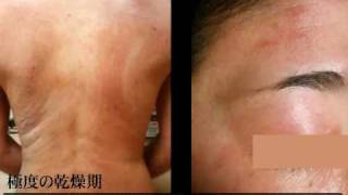 アトピー性皮膚炎　30代女性のアトピー闘病記録