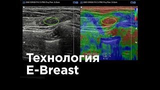 Технология E-Breast - эластография молочной железы