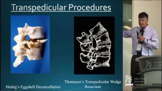 Spinal Deformity Surgery - Sigurd Berven, MD