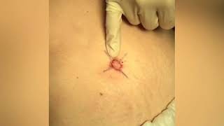 Bellybutton revision in 60 Seconds - Dr. Anthony Youn