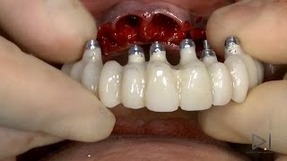 THE ART OF DIGITAL IMPLANTOLOGY FAENZA 20/21/22 Aprile 2017 dr.CIABATTONI dr.ACOCELLA