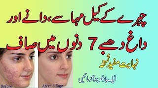 Chehre ke keel mahase daag dhabe 7 dino main khatam