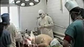 Ампутация 2,3 бедра Учебный фильм 2001г. часть 1