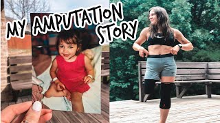 How I Lost My Leg & Became an Amputee | Alcequine
