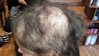 Trichotillomania: HOW to COVER hair loss in 2019 "HAIR PULLING SOLUTION"