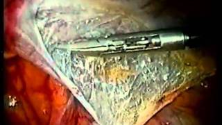 Laparoscopic inguinal hernia TAPP - UCSF  Quan-Yang Duh, MD