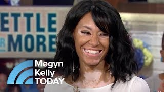 Vitiligo Didn’t Stop This Young Woman From Becoming A CoverGirl Model | Megyn Kelly TODAY