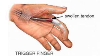 Trigger Finger