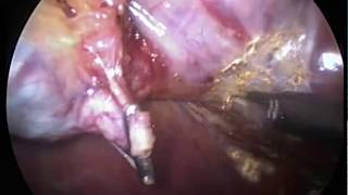 Cirurgia de pedra na vesícula por video laparoscopia - Colecistectomia
