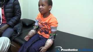 3yr old Bilateral Below Elbow Amputee receives 1st MyoElectric Prostheses