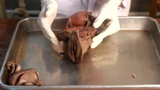 Female Genitalia : Ovary,Fallopian tube and parts of it with anatomical points (part 1)
