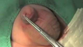 Circumcision