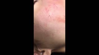 Nặn mụn ẩn lâu năm nhân cứng để lâu hậu quả vô cùng nặng nề - Ngọc Nguyễn