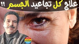 وصفات حصرية وجديدة لعلاج التجاعيد في أي منطقة في الجسم مع الدكتور جمال الصقلي 2018 ?