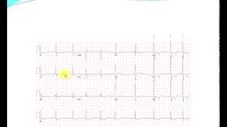 Invata bazele electrocardiogramei EKG