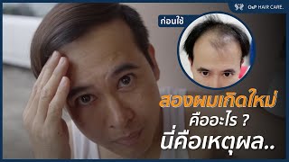 HERRMETTO แก้หัวล้าน ผมบาง ผมร่วง คุณสมพงษ์ คำปิง ก่อนและหลังใช้