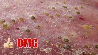 How To Removal Blackheads & Whiteheads On The Face Easy Acne Treatment On Face #391