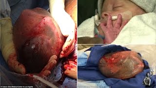 Baby born with amniotic sac intact, placenta and umbilical cord tucked inside